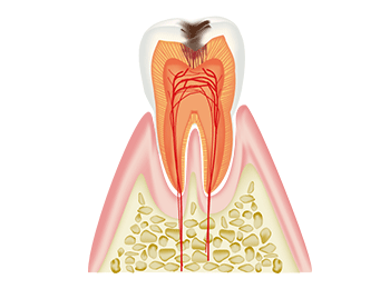 歯の内部まで進行したむし歯