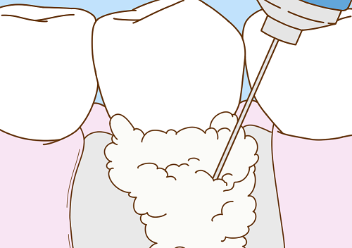 歯周外科と再生療法