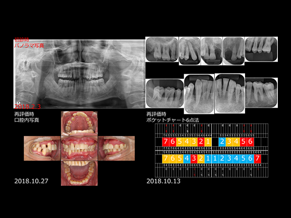 当院における“むし歯”や“歯周病”に対する取り組み