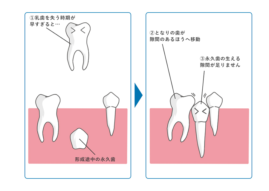 生え変わりの時期の乳歯の重要な役割